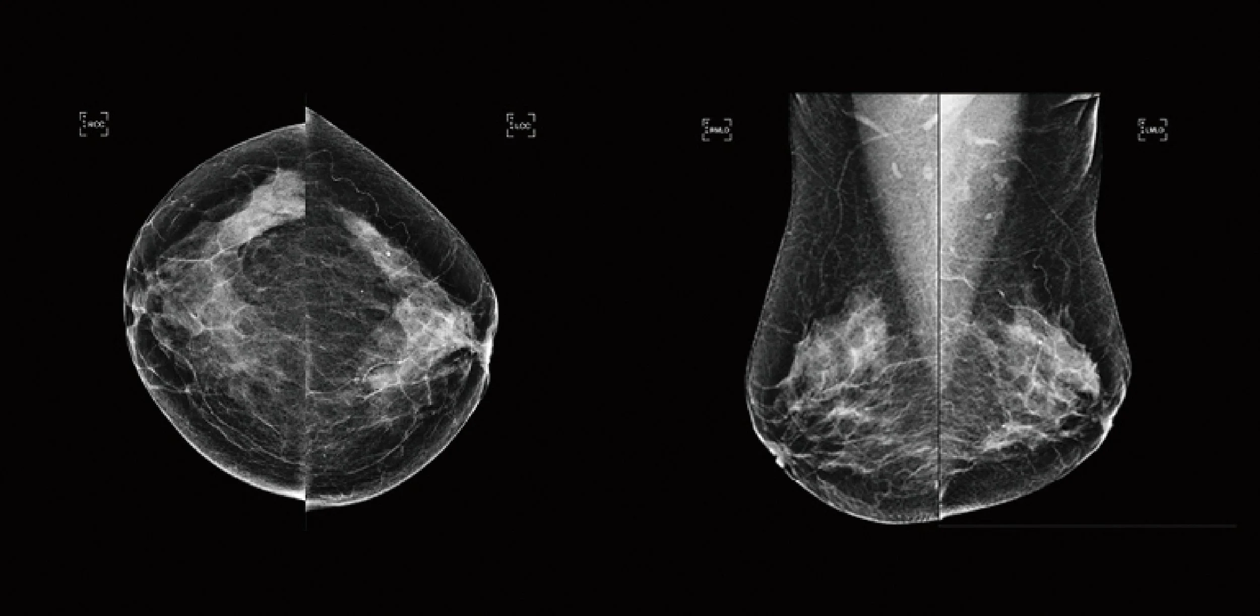 Women's Imaging Services | Second Read | Artificial Intelligence